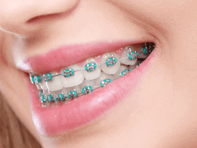 Funny Names for Braces